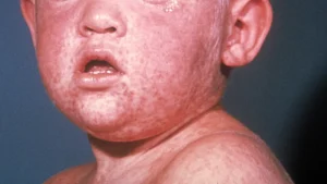 Face of a boy 3 days with measles rash